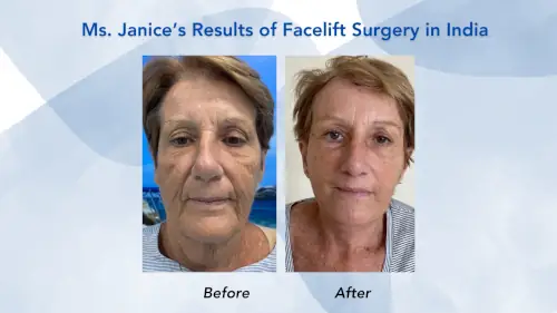 Results of Facelift Surgery in India